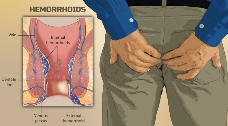 What can be mistaken for hemorrhoids?